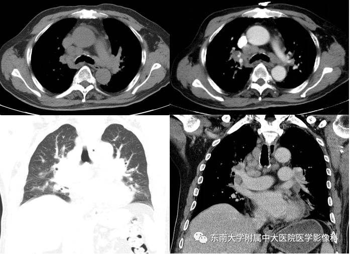 【病例】肺结节病1例CT影像表现