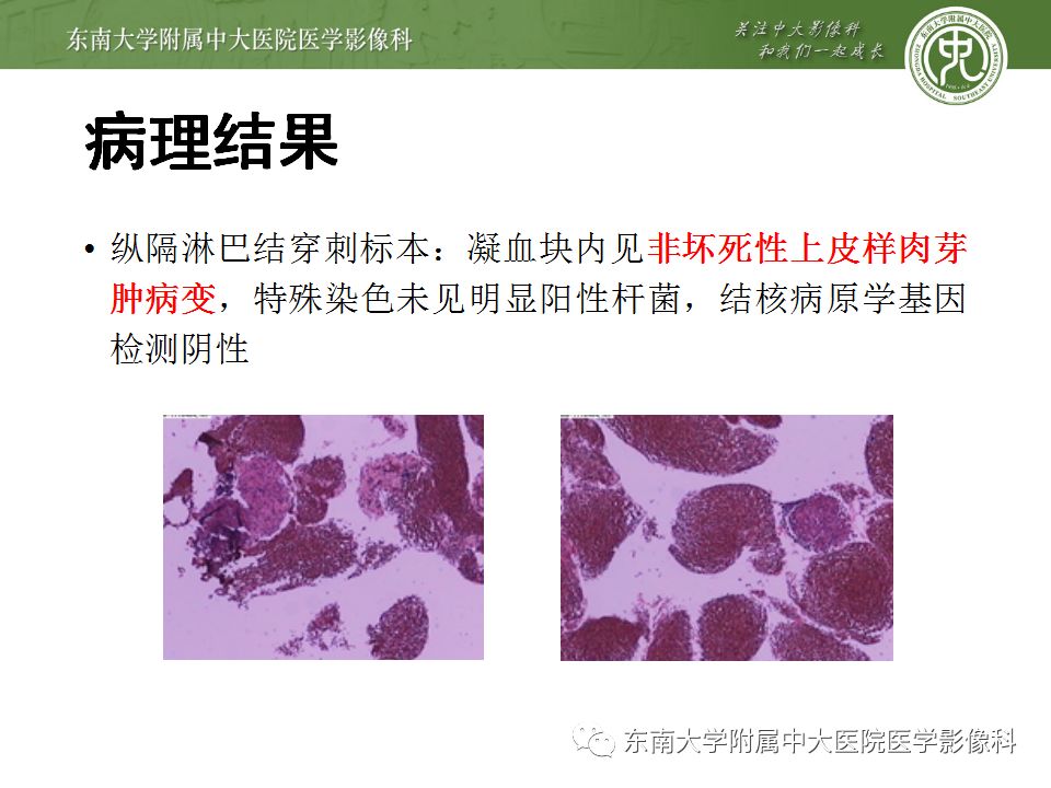 【病例】肺结节病1例CT影像表现