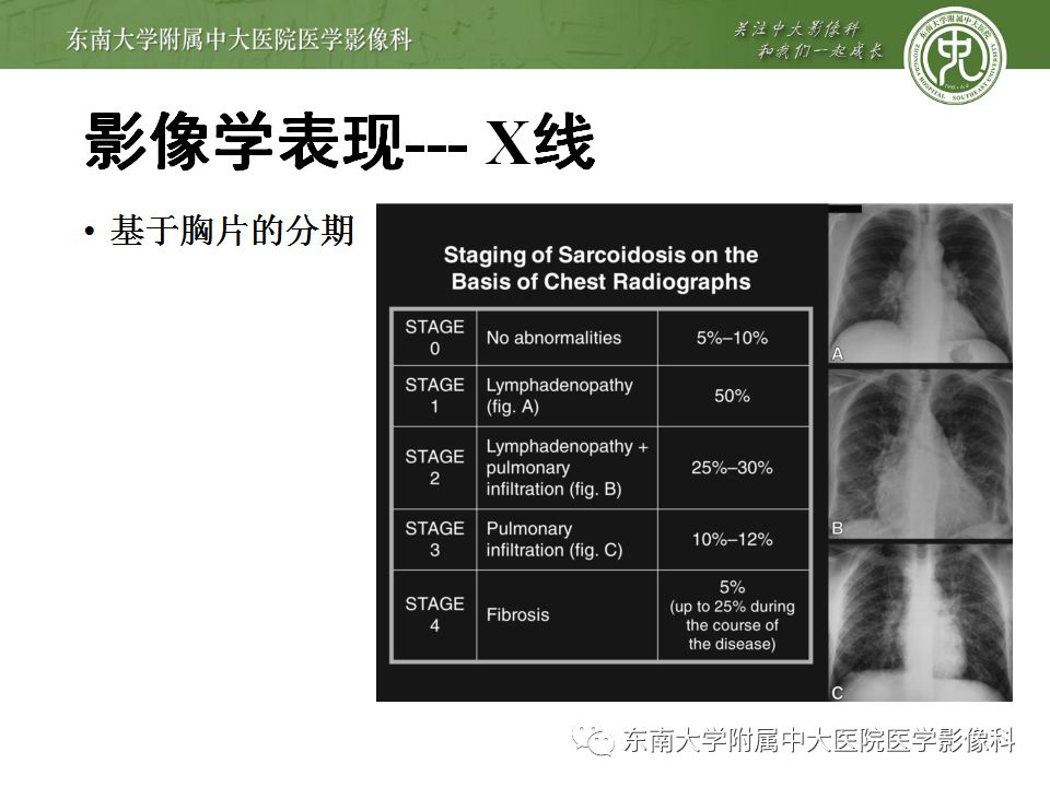 【病例】肺结节病1例CT影像表现