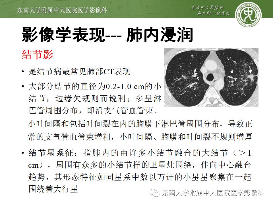【病例】肺结节病1例CT影像表现