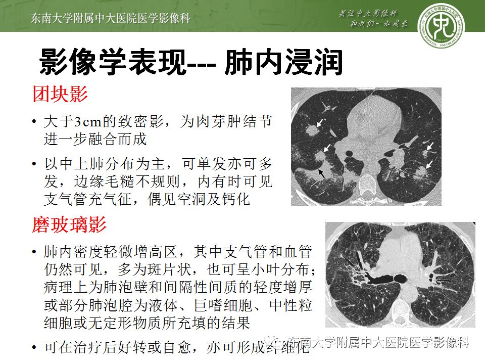 【病例】肺结节病1例CT影像表现