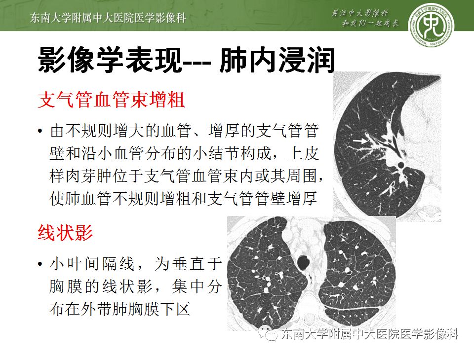 【病例】肺结节病1例CT影像表现