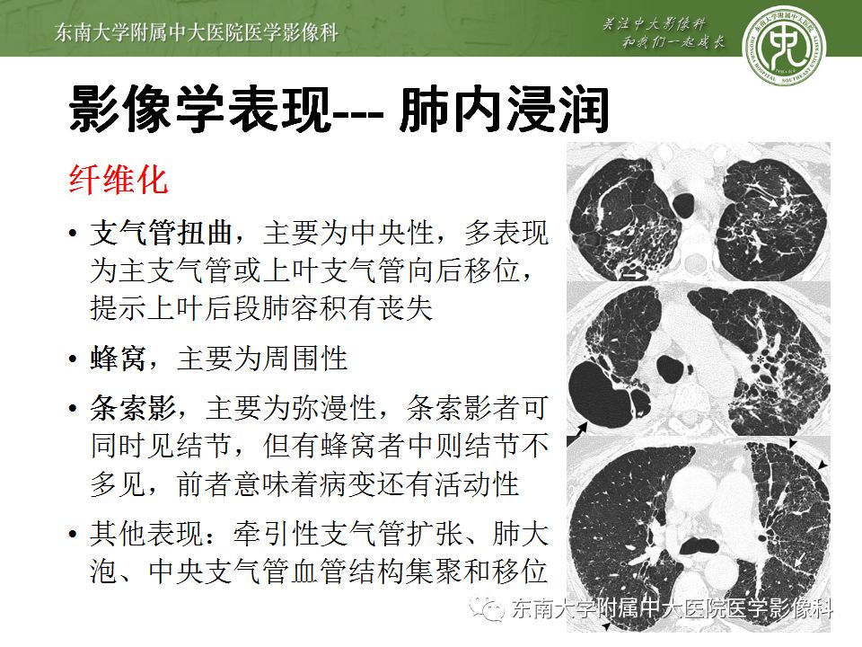 【病例】肺结节病1例CT影像表现