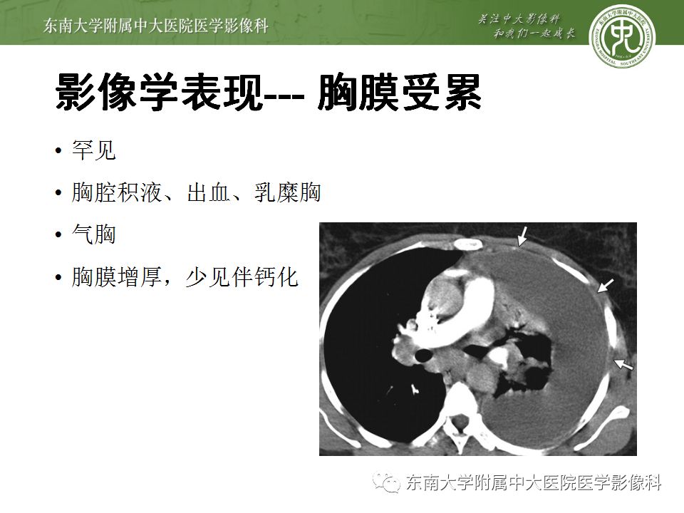 【病例】肺结节病1例CT影像表现