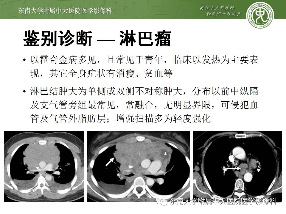 【病例】肺结节病1例CT影像表现
