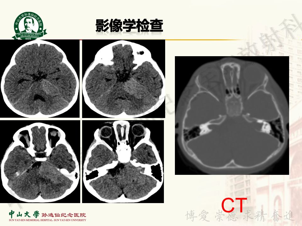 【病例】非典型畸胎瘤/横纹肌样瘤1例CT及MR