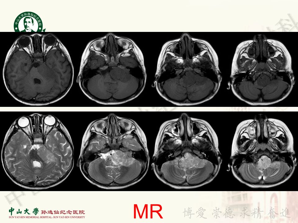 【病例】非典型畸胎瘤/横纹肌样瘤1例CT及MR