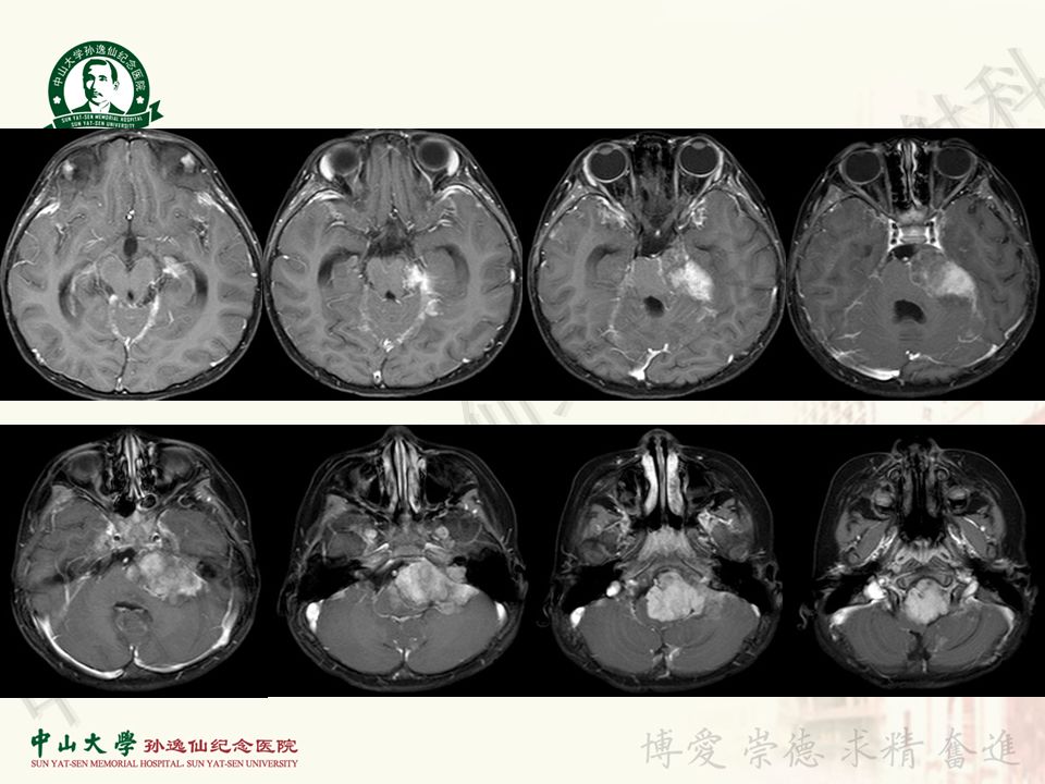 【病例】非典型畸胎瘤/横纹肌样瘤1例CT及MR