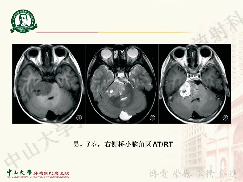 【病例】非典型畸胎瘤/横纹肌样瘤1例CT及MR