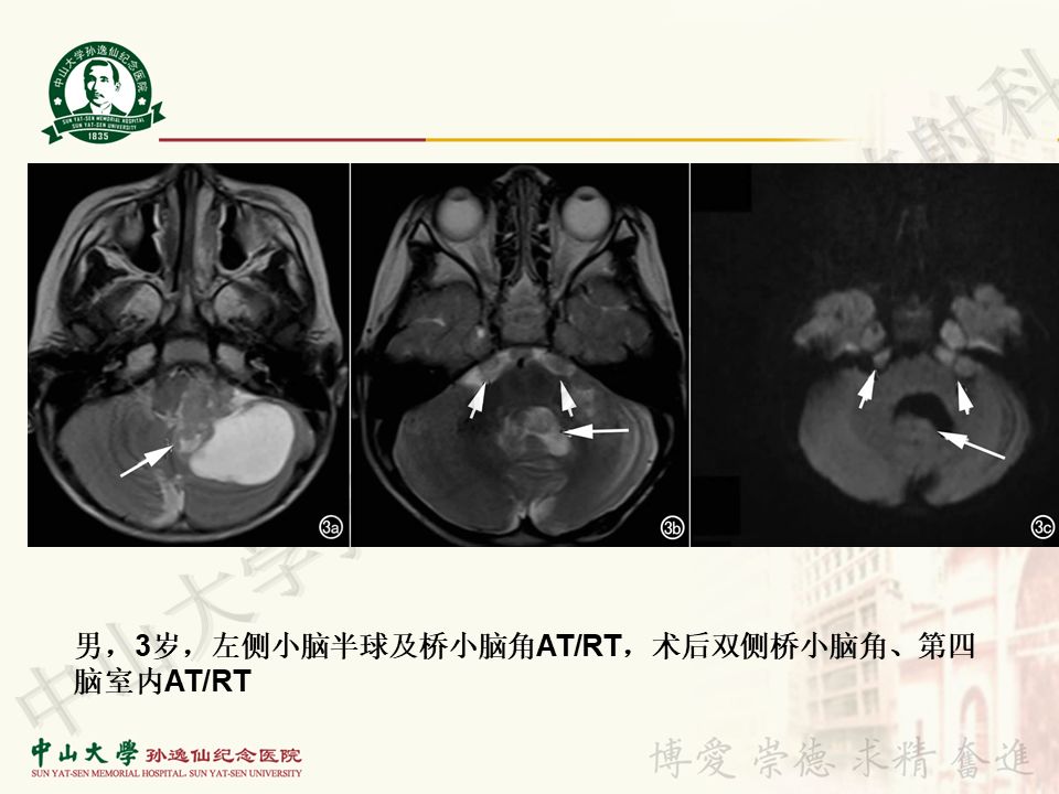 【病例】非典型畸胎瘤/横纹肌样瘤1例CT及MR