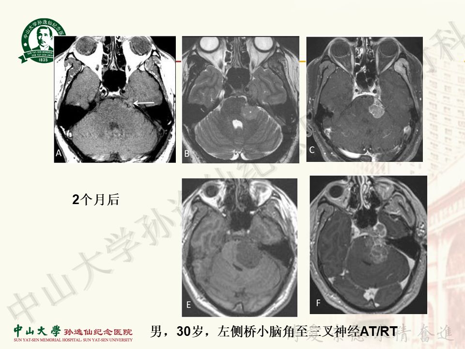 【病例】非典型畸胎瘤/横纹肌样瘤1例CT及MR