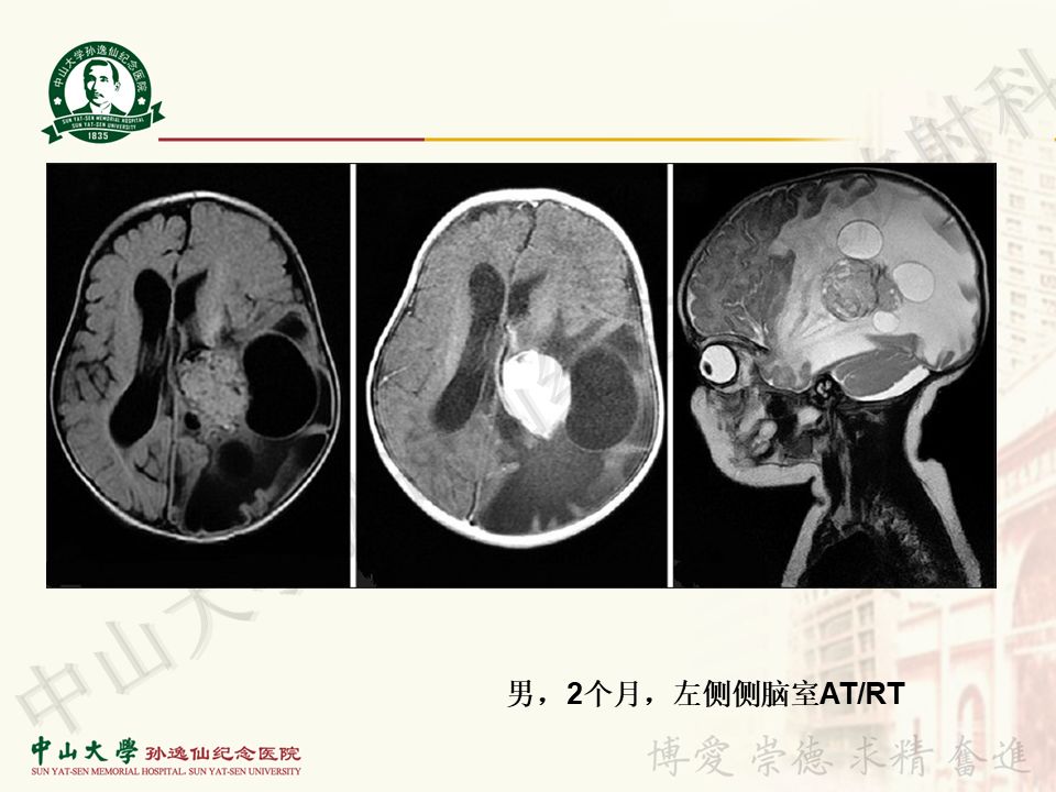 【病例】非典型畸胎瘤/横纹肌样瘤1例CT及MR