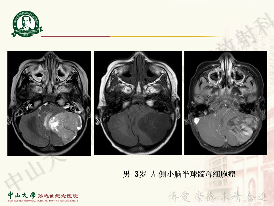 【病例】非典型畸胎瘤/横纹肌样瘤1例CT及MR