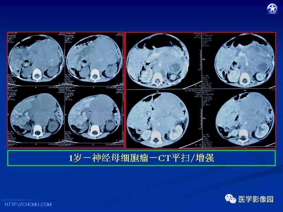 【PPT】儿童腹膜后神经节源性肿瘤的影像诊断