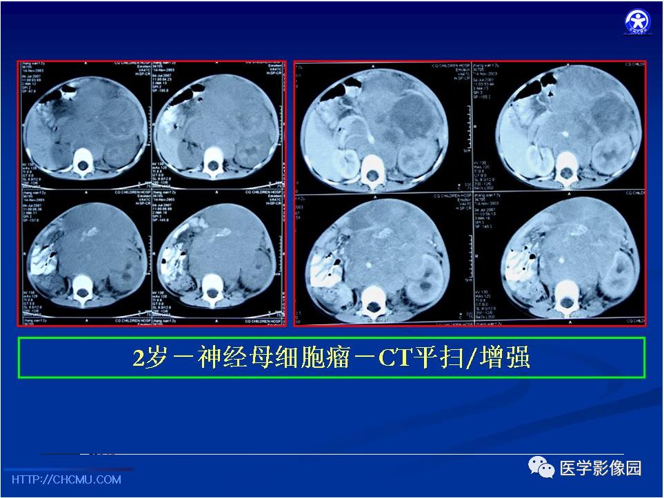 【PPT】儿童腹膜后神经节源性肿瘤的影像诊断