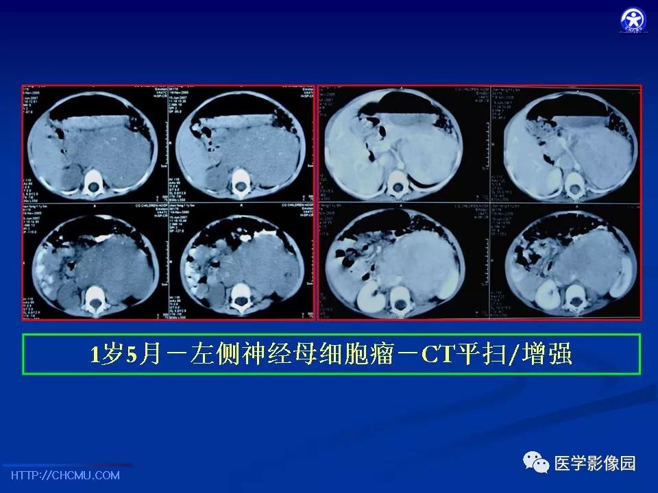 【PPT】儿童腹膜后神经节源性肿瘤的影像诊断