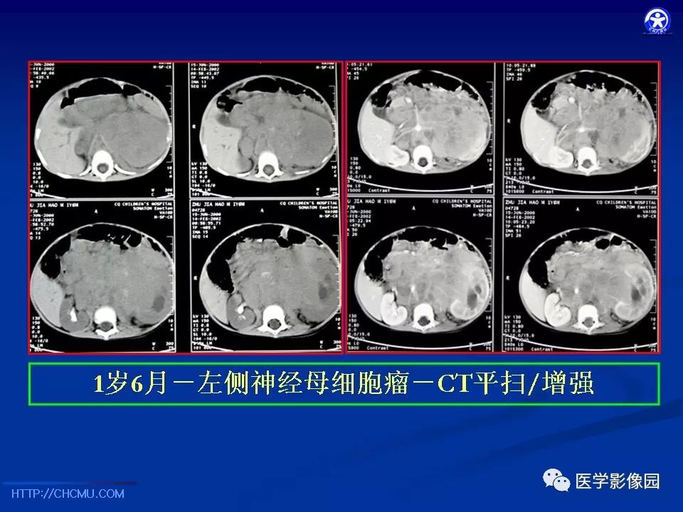 【PPT】儿童腹膜后神经节源性肿瘤的影像诊断