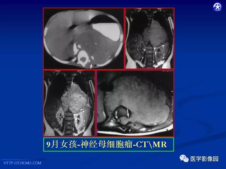【PPT】儿童腹膜后神经节源性肿瘤的影像诊断