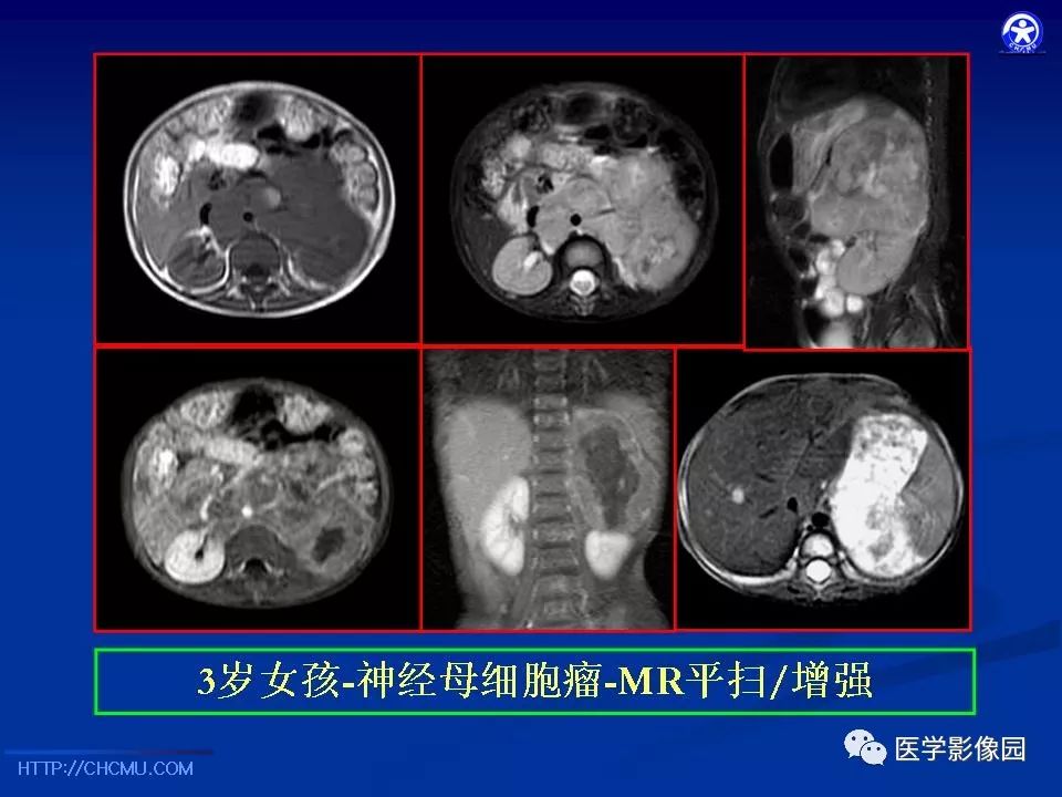 【PPT】儿童腹膜后神经节源性肿瘤的影像诊断