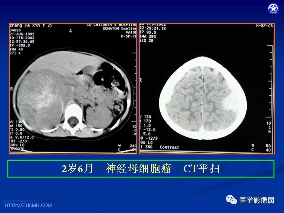 【PPT】儿童腹膜后神经节源性肿瘤的影像诊断