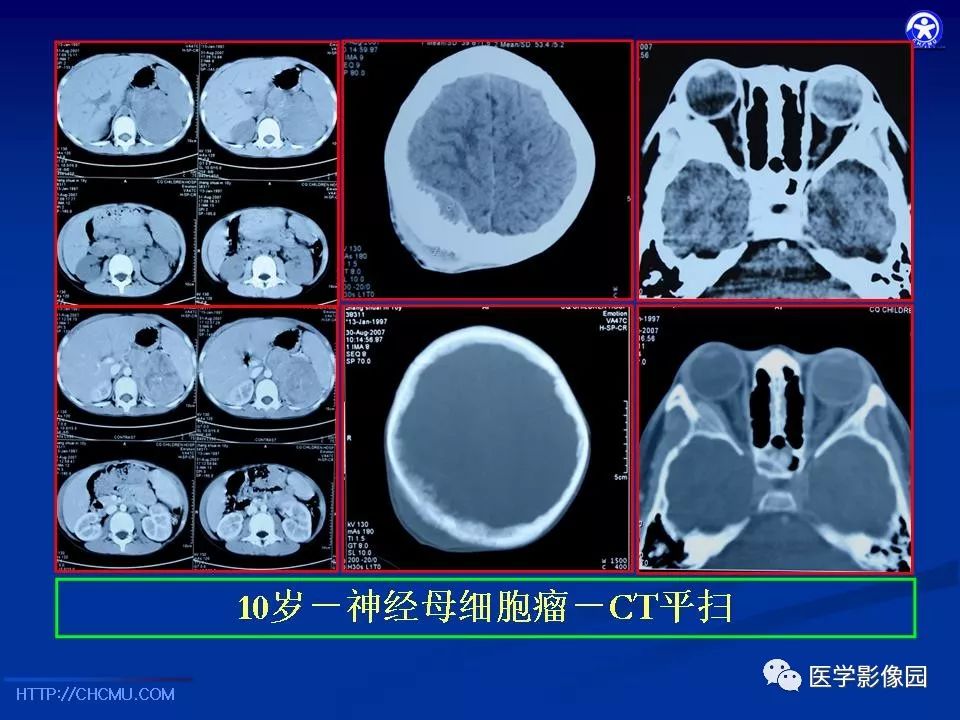 【PPT】儿童腹膜后神经节源性肿瘤的影像诊断
