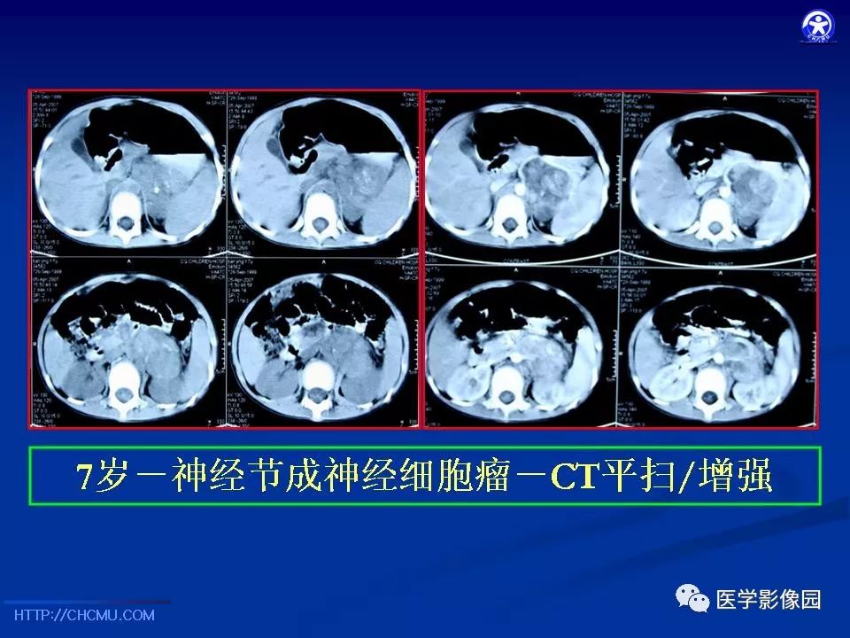【PPT】儿童腹膜后神经节源性肿瘤的影像诊断