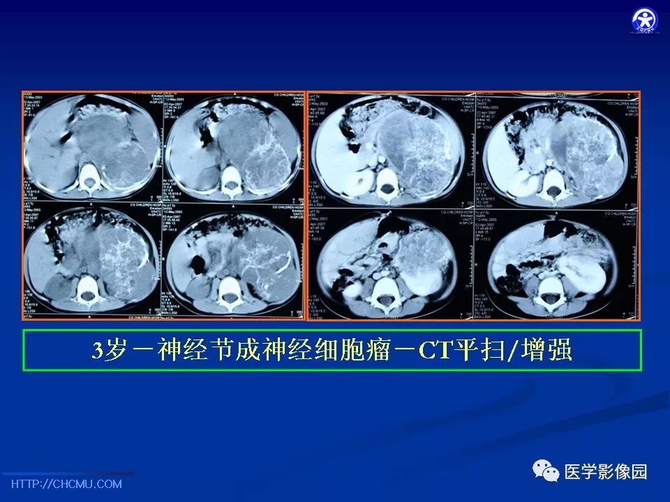【PPT】儿童腹膜后神经节源性肿瘤的影像诊断