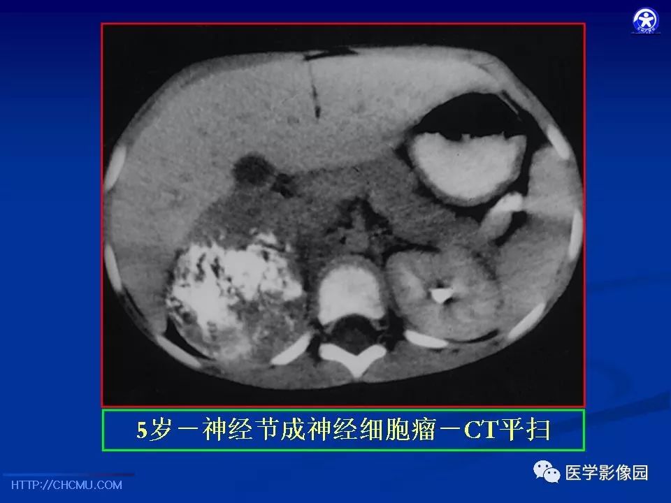 【PPT】儿童腹膜后神经节源性肿瘤的影像诊断