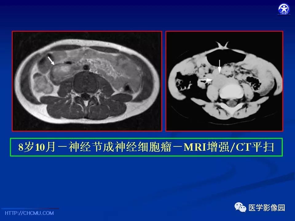 【PPT】儿童腹膜后神经节源性肿瘤的影像诊断