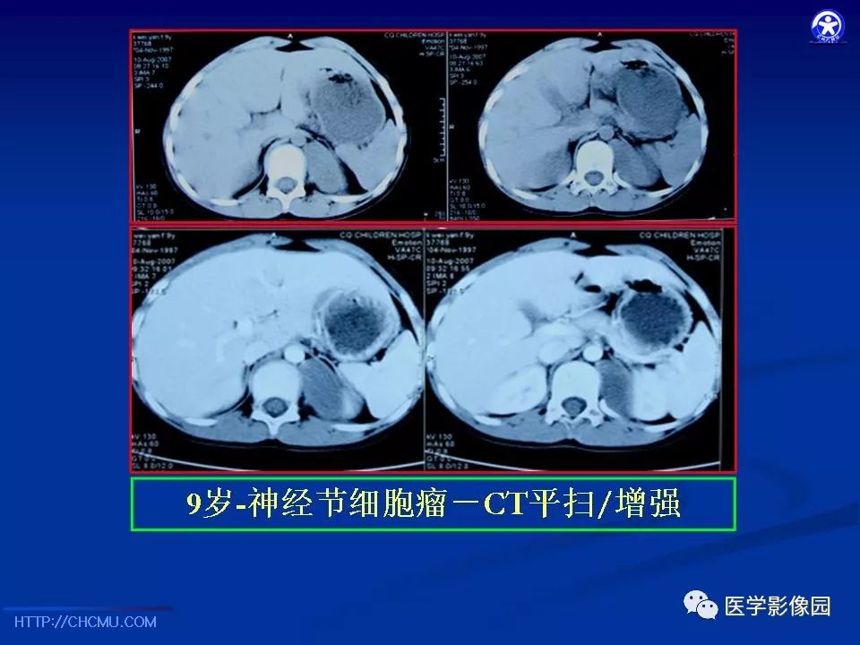 【PPT】儿童腹膜后神经节源性肿瘤的影像诊断