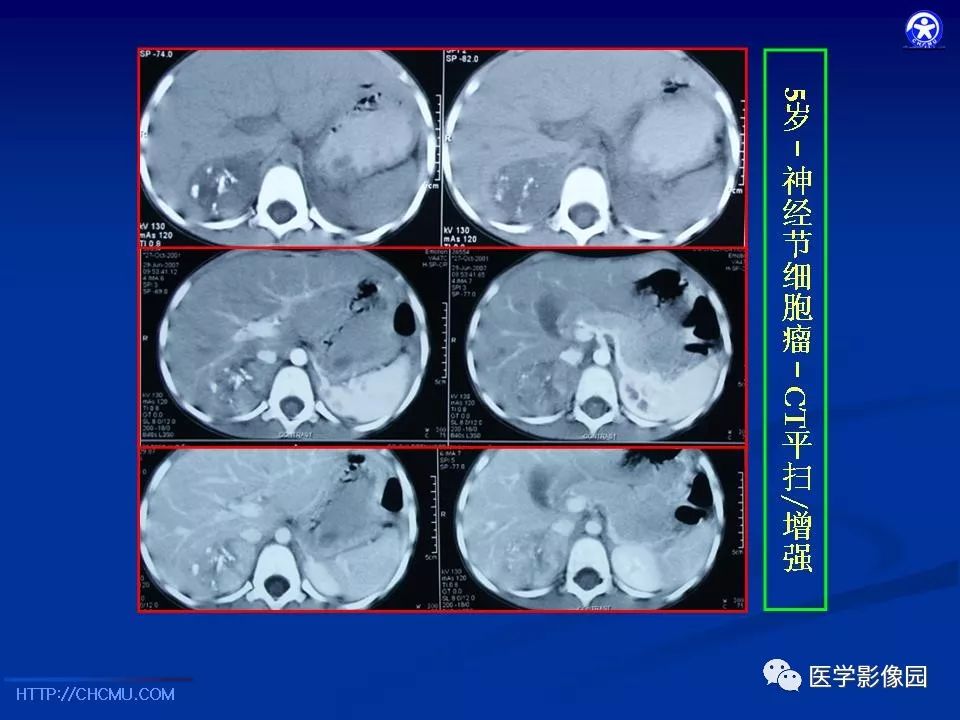 【PPT】儿童腹膜后神经节源性肿瘤的影像诊断