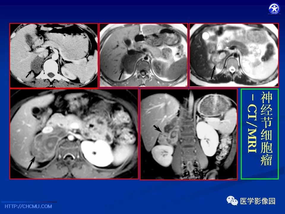 【PPT】儿童腹膜后神经节源性肿瘤的影像诊断