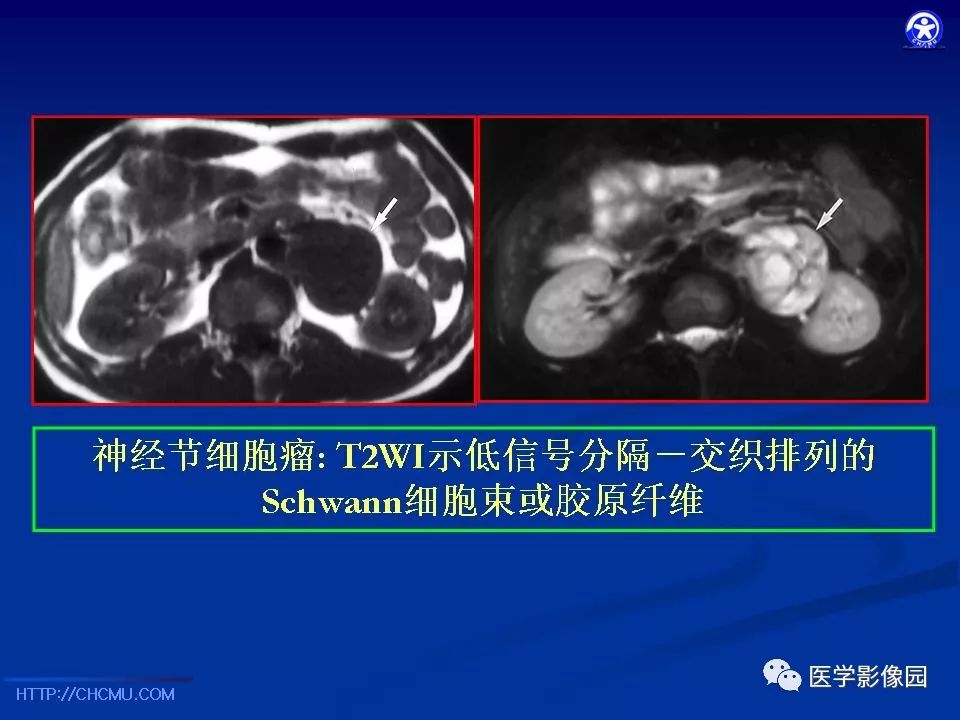 【PPT】儿童腹膜后神经节源性肿瘤的影像诊断