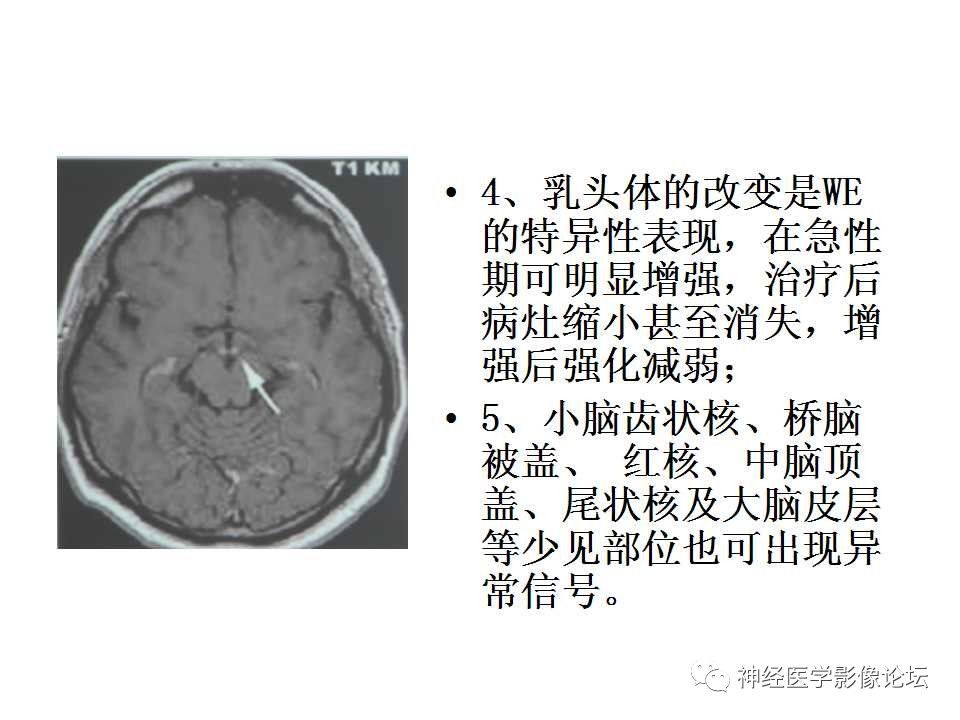 【病例】Wernicke脑病1例MR