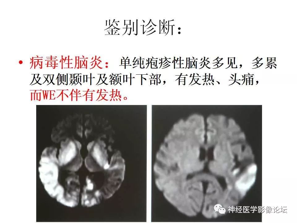 【病例】Wernicke脑病1例MR