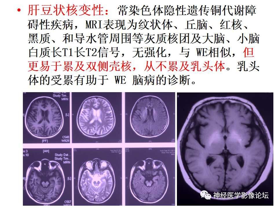 【病例】Wernicke脑病1例MR