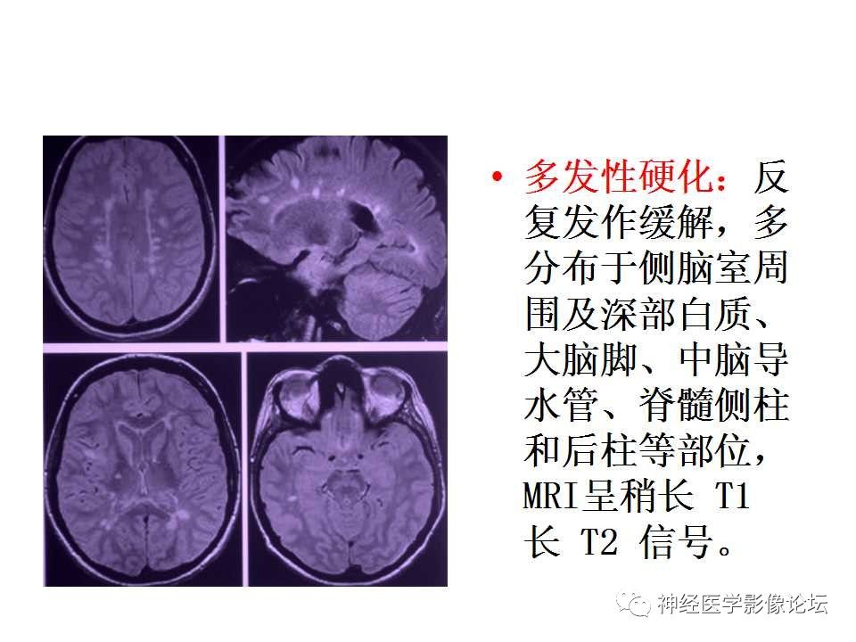 【病例】Wernicke脑病1例MR