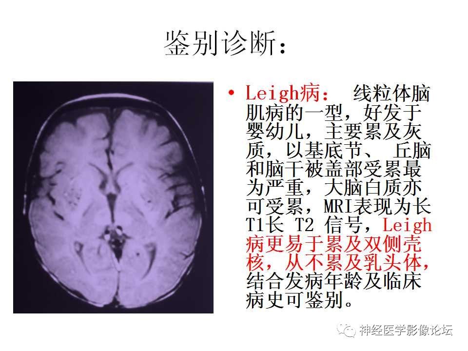 【病例】Wernicke脑病1例MR