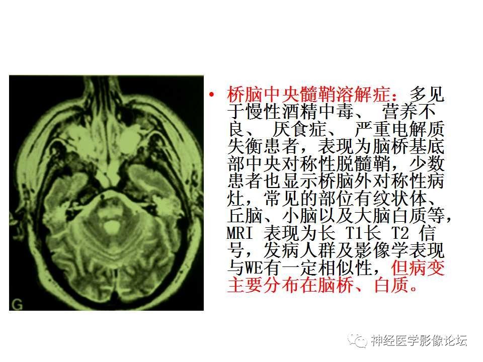 【病例】Wernicke脑病1例MR