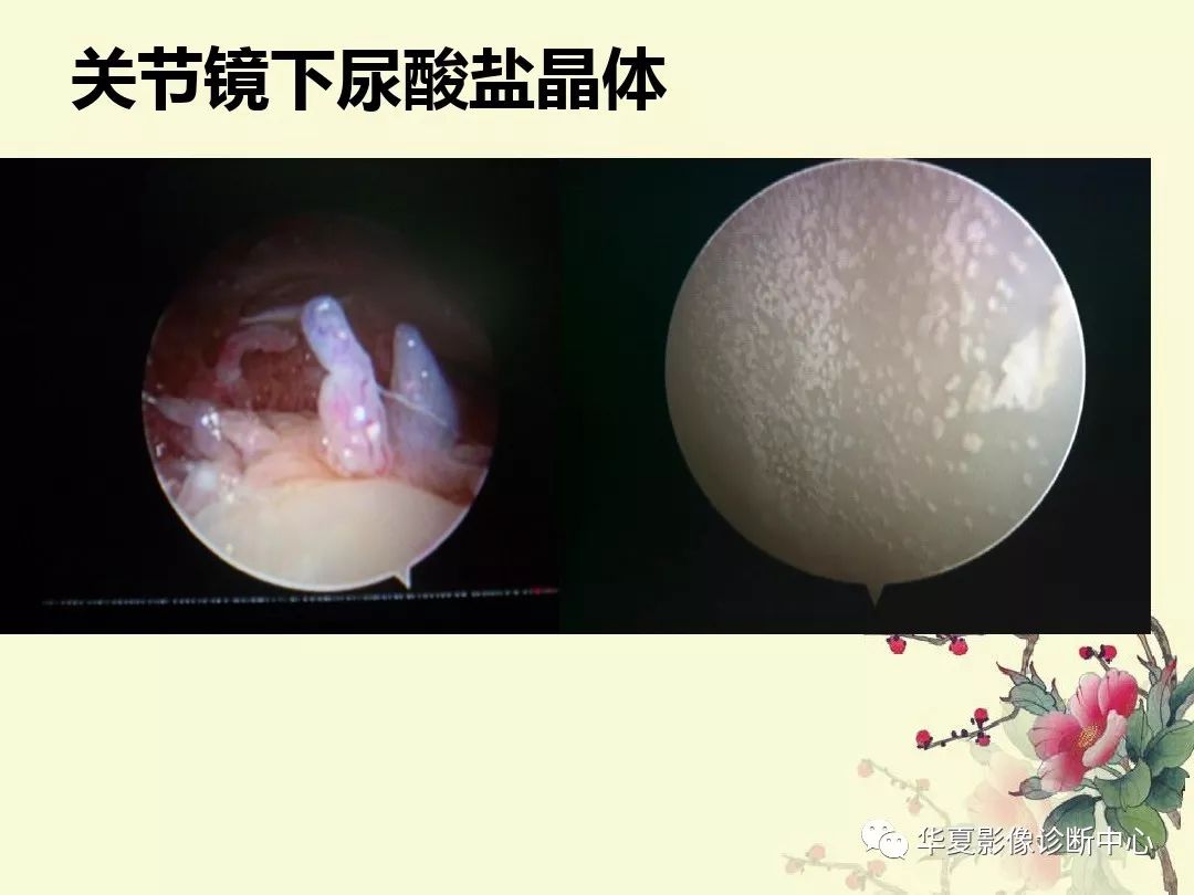 【PPT】痛风性关节炎及假性痛风