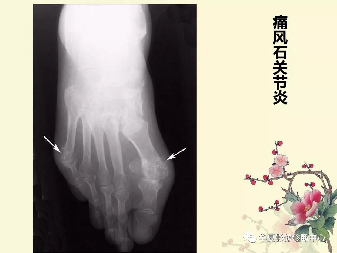 【PPT】痛风性关节炎及假性痛风