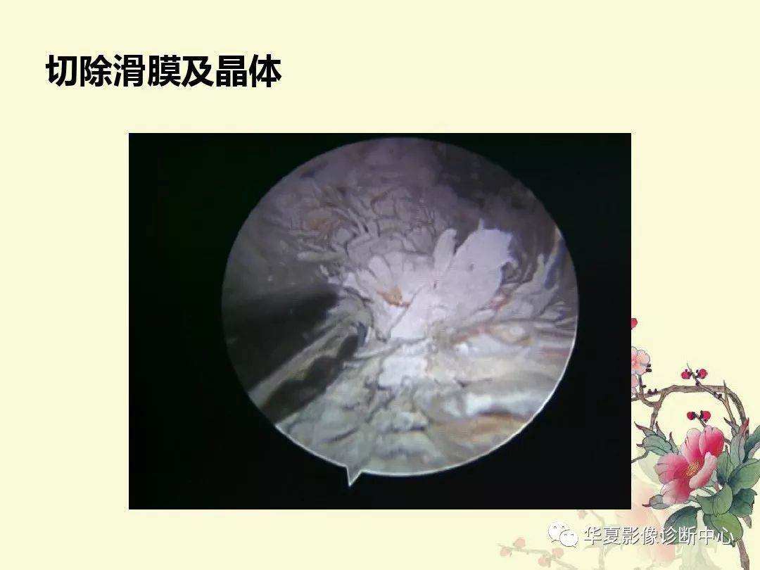 【PPT】痛风性关节炎及假性痛风