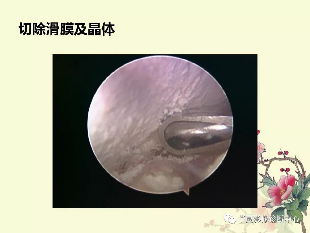 【PPT】痛风性关节炎及假性痛风