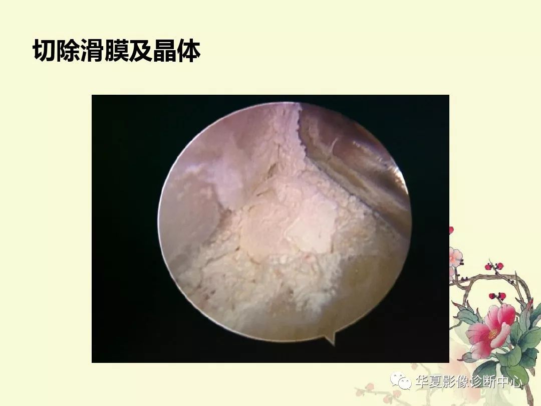 【PPT】痛风性关节炎及假性痛风