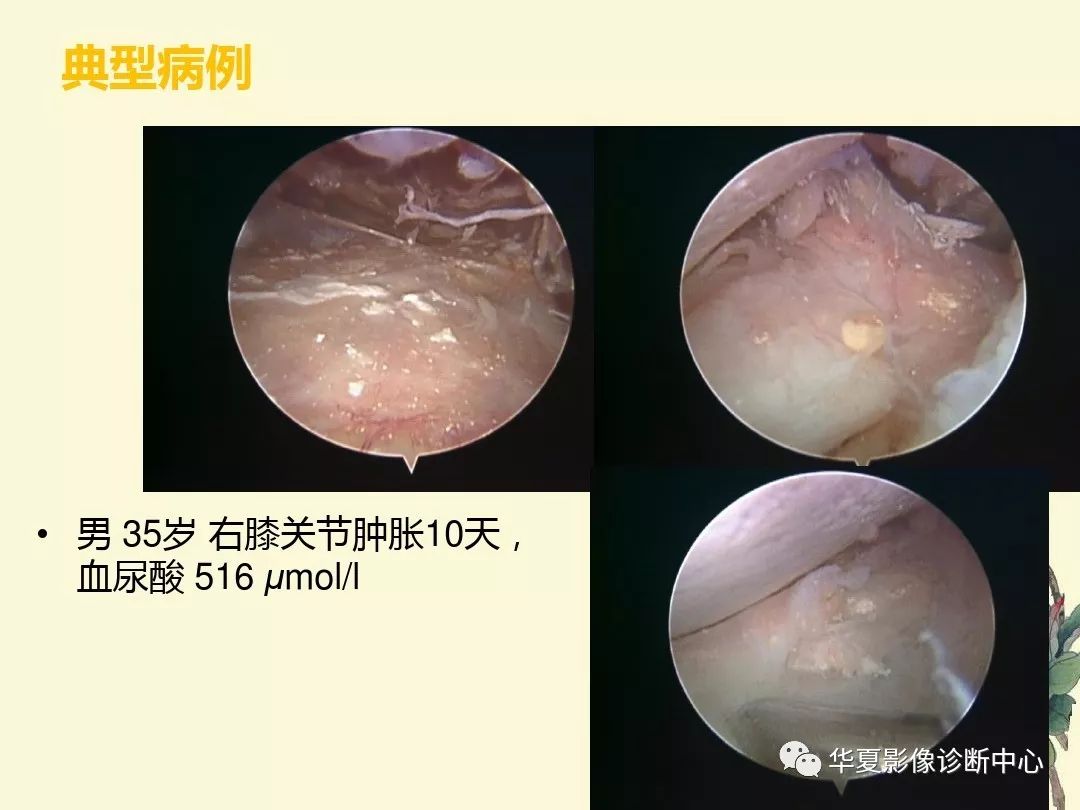 【PPT】痛风性关节炎及假性痛风