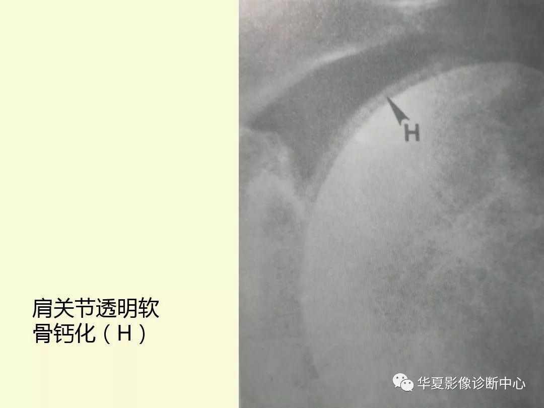 【PPT】痛风性关节炎及假性痛风