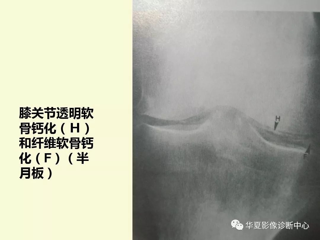 【PPT】痛风性关节炎及假性痛风
