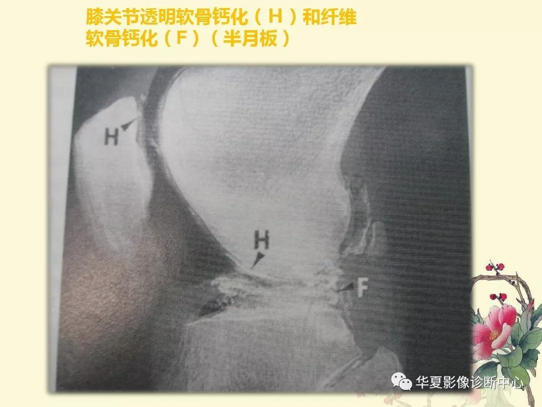 【PPT】痛风性关节炎及假性痛风