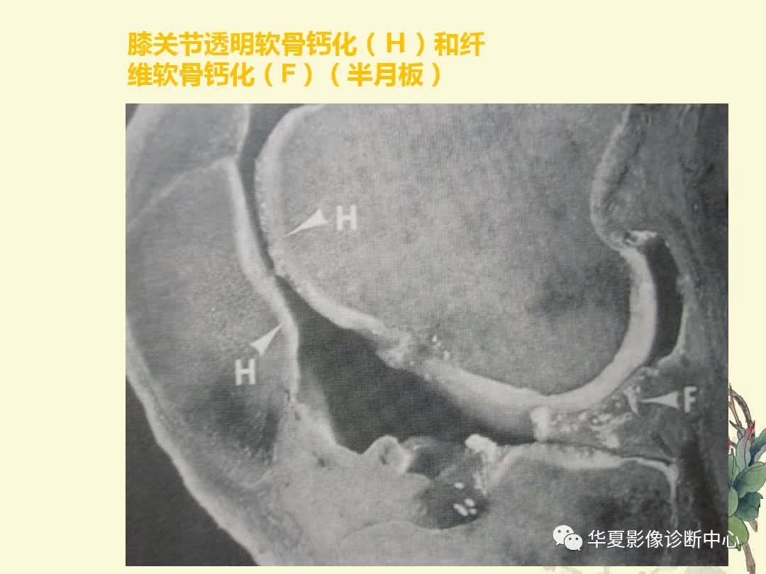 【PPT】痛风性关节炎及假性痛风