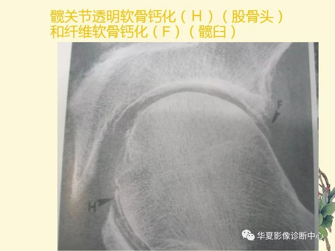 【PPT】痛风性关节炎及假性痛风